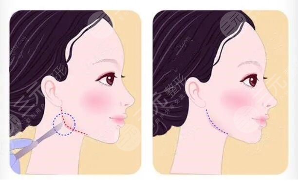 女士肥胖下頜角整形注意事項(xiàng)