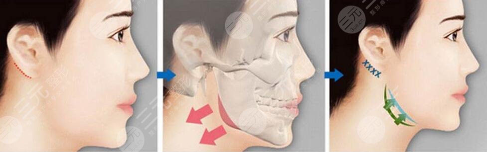 女士肥胖下頜角整形的好處