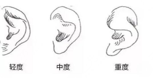杯狀耳整形