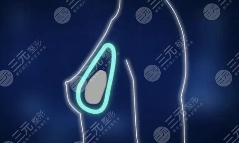 娜綺麗隆胸術(shù)后注意事項(xiàng)