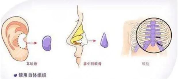 自體軟骨隆鼻有哪些優(yōu)缺點
