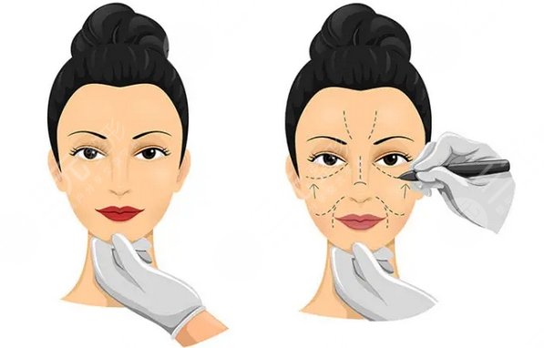 拉皮就是把頭皮割掉嗎