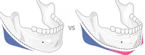 V-line瓜子臉的優(yōu)勢(shì)