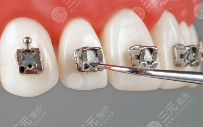 維樂口腔正畸科普