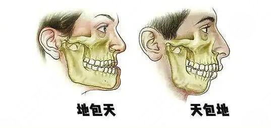 天包地矯正后臉型變化圖共享，矯正前的“如花”，矯正后的“側(cè)顏女神”~
