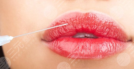案例|嘟嘟唇打完5天內(nèi)的圖片