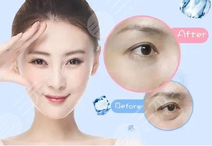 中山三院雙眼皮做的好嗎