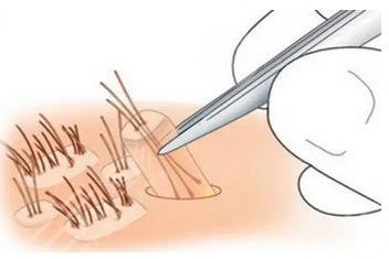 植發(fā)多少錢