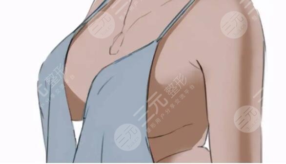 娜綺麗隆胸多少錢更合理？為什么有的姐妹花費(fèi)11萬巨款？是物超所值嗎？