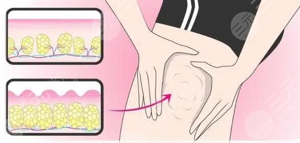 光纖溶脂瘦大腿項目原理
