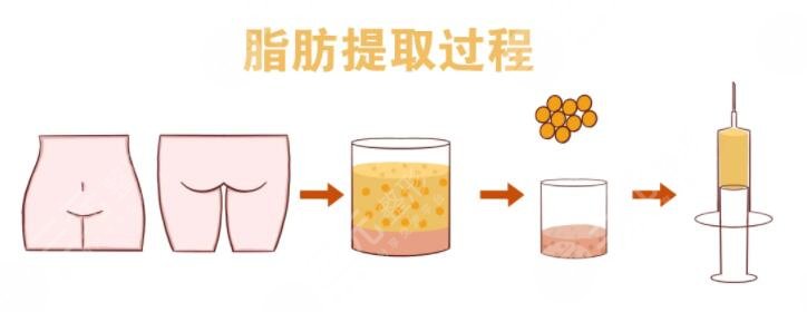 全臉脂肪填充的副作用