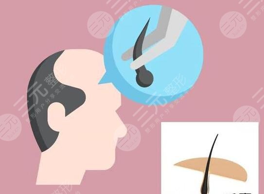 植發(fā)手術(shù)的費(fèi)用影響因素：