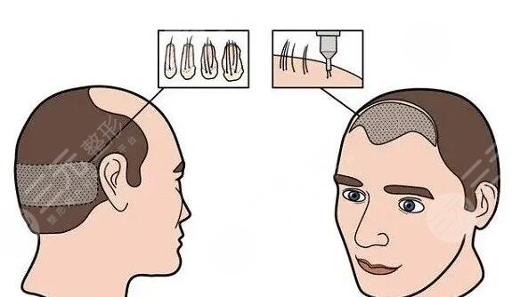 植發(fā)手術(shù)有哪些需要注意的?