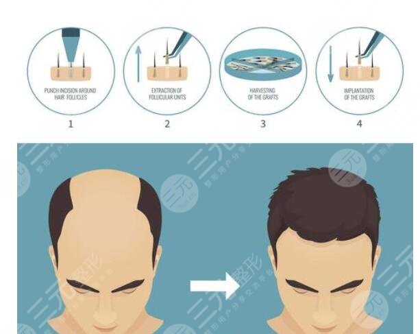 植發(fā)手術(shù)怎么護(hù)理?