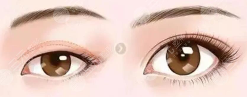 北醫(yī)三院安陽(yáng)割雙眼皮案例