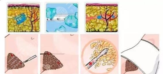 腹部吸脂減肥價格如何？