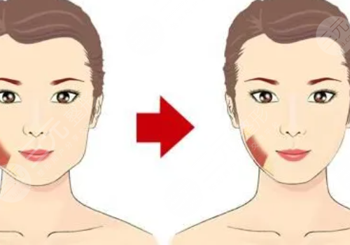 怎么減小咬肌大小?