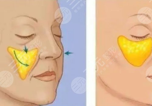 自體脂肪豐蘋(píng)果肌果好嗎?