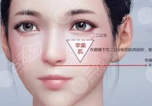 自體脂肪豐蘋(píng)果肌果好嗎?