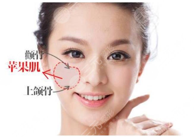 自體脂肪豐蘋果肌果好嗎