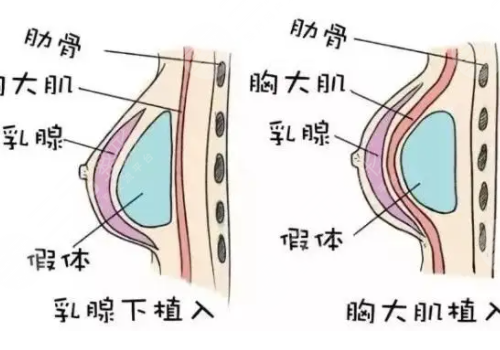 假體隆胸手感和真的有沒(méi)有區(qū)別?