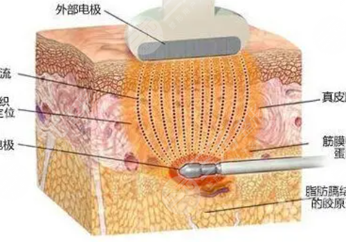 鐳射溶脂和激光溶脂的優(yōu)勢