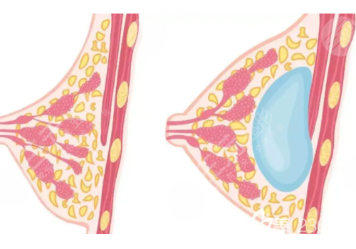 假體隆胸手感和真的有沒(méi)有區(qū)別?