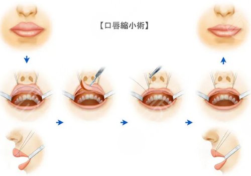 厚唇變薄手術(shù)多少錢？