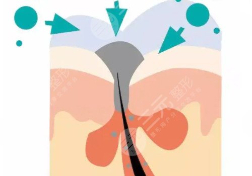 果酸美白果好嗎?