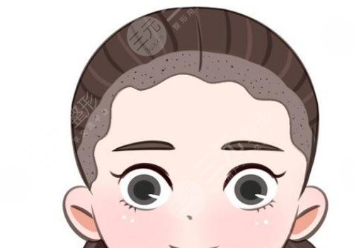 發(fā)際線移植能保持多久？