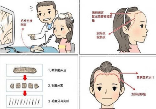 發(fā)際線移植能保持多久？