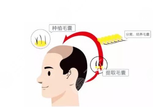 發(fā)際線移植能保持多久？