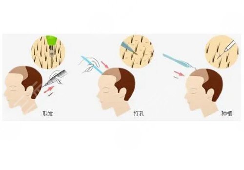 發(fā)際線移植能保持多久？