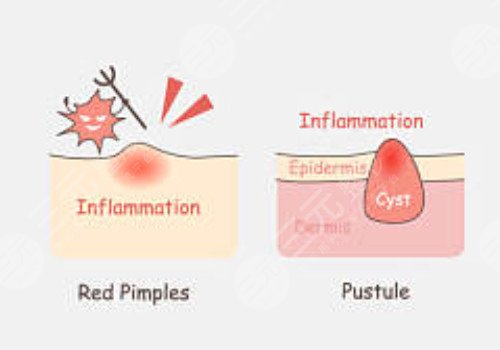 臉上長(zhǎng)痘印如何消除?