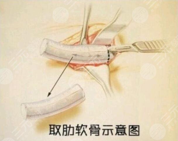 自體肋軟骨隆鼻