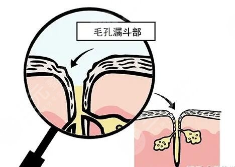 如何收縮鼻頭毛孔小妙招!