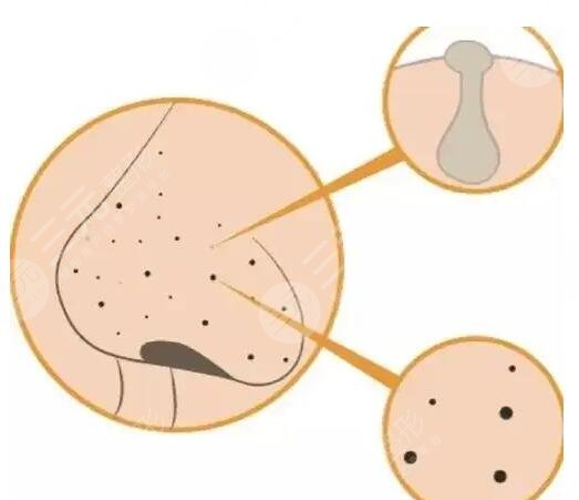 激光是如何改變毛孔粗大的?