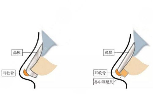 自體軟骨隆鼻多少錢?