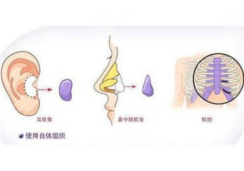 自體軟骨隆鼻多少錢?