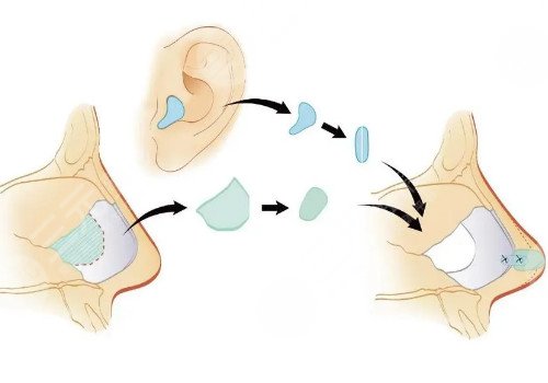 自體軟骨隆鼻多少錢?