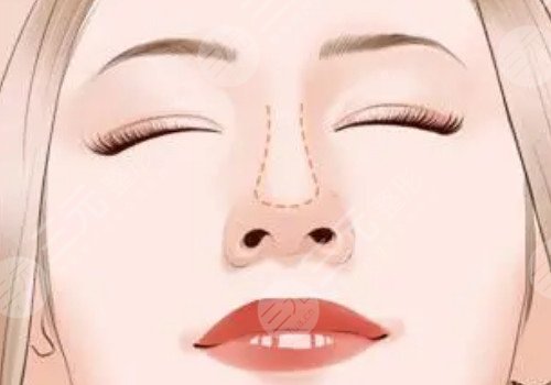 自體軟骨隆鼻多少錢?