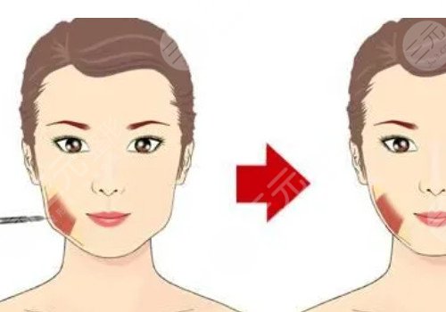咬肌發(fā)達(dá)怎么瘦下來(lái)?