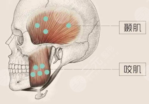 咬肌發(fā)達(dá)怎么瘦下來(lái)?