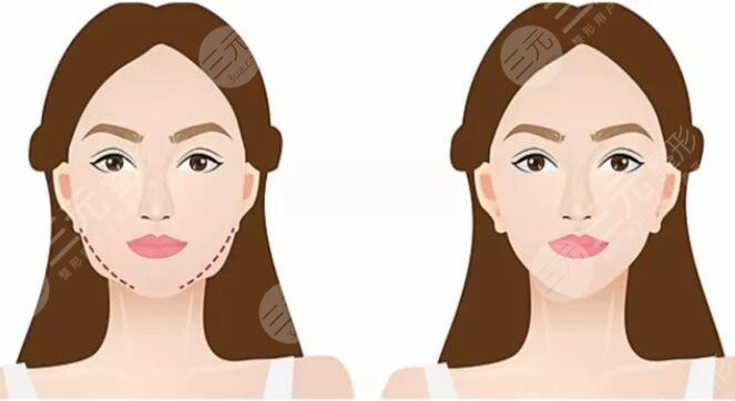 咬肌大怎么辦怎么改良快速又有？