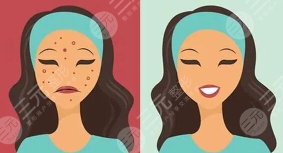 　　臉上的痘坑怎么去掉?隨著年齡的增長(zhǎng)，不少人臉上都出現(xiàn)了青春痘或者是長(zhǎng)痘的情況，這些多數(shù)是由內(nèi)分泌失調(diào)和皮膚油脂平衡失調(diào)造成的，首先在發(fā)現(xiàn)自己長(zhǎng)痘之后，就需要通過(guò)正規(guī)的祛痘手術(shù)去除痘痘才行，如果是不正規(guī)的方法就容易造成痘坑、痘印，對(duì)于小伙伴們來(lái)說(shuō)，痘坑痘印比痘痘更讓人難受，目前國(guó)內(nèi)可以去痘坑的方法有很多，都是國(guó)內(nèi)祛痘坑成功的小伙伴們選擇的技術(shù)手段，下面就有小編一一來(lái)為大家做一個(gè)介紹!  　　1、臉上的痘坑怎么去掉更有?  　　(1)、激光祛痘坑，利用高熱能量的激光，在皮膚表面進(jìn)行照射，光能對(duì)痘坑位置有一定的刺激作用，能夠刺激膠原蛋白的再生和膠原纖維的修復(fù)生長(zhǎng)，從而達(dá)到修復(fù)痘坑的果。  　　(2)、果酸換膚，果酸換膚主要是在痘坑皮膚表面涂抹果酸，利用專業(yè)的器械設(shè)備刺激手術(shù)部位的皮膚細(xì)胞再生，加速痘坑區(qū)域的新陳代謝來(lái)達(dá)到去除痘坑，讓皮膚看起來(lái)光滑平整的手術(shù)果。  　　(3)、微針緩解，微針緩解是很多美容院都會(huì)采取的一種改良痘坑的方法，能夠?qū)⒍豢游恢玫钠つw層次重新進(jìn)行疏通，輸入一定的營(yíng)養(yǎng)物質(zhì)，使皮膚的修復(fù)能力上線來(lái)達(dá)到去除痘印的果。  　　(4)、填充祛除，填充的技術(shù)手段所針對(duì)的是痘坑，比較嚴(yán)重的人群，特有的一種技術(shù)方法，將專業(yè)的填充材料填充到痘坑凹陷比較嚴(yán)重的位置來(lái)讓痘坑平整。  　　(5)、DIY面膜，如果是針對(duì)于痘坑比較淺或者是新出現(xiàn)的痘坑的話，可以通過(guò)護(hù)膚品等方式來(lái)讓自己的痘坑有一定的修復(fù)果，其中比較受求美者喜歡的是蛋清珍珠粉，面膜蛋清和珍珠粉融合之后涂抹在面部一5到20分鐘左右，用清水清洗一周敷兩次左右，一段時(shí)間之后可以有一定淡化痘坑的果。  　　2、激光祛痘印痘坑多少錢?  　　激光去除痘坑痘印的價(jià)格通常在2千到一萬(wàn)元不等，首先緩解面積是影響價(jià)格的關(guān)鍵，如果是小面積的痘坑，那么它的手術(shù)難度就比較小，費(fèi)用也會(huì)比較便宜，但如果是面積較大且又深的痘坑的話，那么它的收費(fèi)價(jià)格就會(huì)在8000元及以上。當(dāng)然醫(yī)院的選擇和地區(qū)的選擇也會(huì)影響到價(jià)格，3甲醫(yī)院的收費(fèi)要比2甲醫(yī)院更貴，私立的整形醫(yī)院和普通的門診部的收費(fèi)標(biāo)準(zhǔn)也有一定的區(qū)別，一線城市和3線城市的醫(yī)療標(biāo)準(zhǔn)也有較大的不同。除了以上兩點(diǎn)以外醫(yī)生的選擇其實(shí)也會(huì)影響到價(jià)格收費(fèi)情況，實(shí)習(xí)醫(yī)生和的祛痘坑醫(yī)生，它的收費(fèi)標(biāo)準(zhǔn)都是不一樣的。  　　3、激光去痘坑要做幾次?  　　一般情況下，激光去痘坑要做3到5次時(shí)間，它主要是通過(guò)皮膚表層深入到皮膚層，為此促進(jìn)皮膚膠原蛋白的再生來(lái)改良痘坑問(wèn)題，但每一個(gè)人的實(shí)際情況是不一樣的，如如果是痘坑比較淺的求美者的話。那么他的激光祛痘坑3次就可以有良好的改良果，反之則要五次。  　　4、微晶磨皮和點(diǎn)陣激光哪個(gè)比較好?  　　這之間都是激光的一種，都可以運(yùn)用到去除疤痕，去除痘坑，去除皺紋，上面不同點(diǎn)在于兩者所使用的材料是不一樣的點(diǎn)，點(diǎn)陣激光采用的是超脈沖和激光掃描，兩者結(jié)合在一起，微晶磨皮則采用的是氫化硅晶體，作為求美者，建議可以直接到醫(yī)院，讓醫(yī)生根據(jù)你的實(shí)際情況給你定制相對(duì)應(yīng)的美容方法，這樣才能有良好的祛痘坑果。