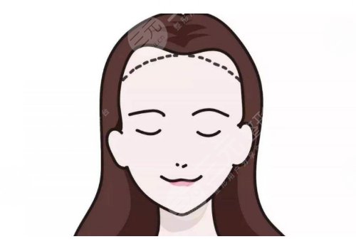 發(fā)際線高怎么挽救?