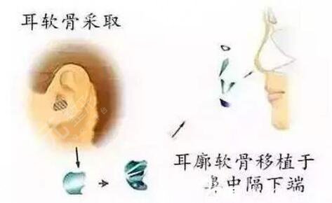 自體軟骨隆鼻果可以維持多久?