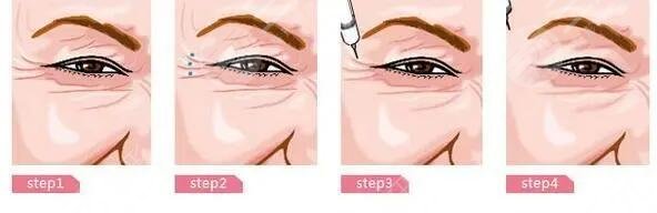 去除魚尾紋有副作用嗎?