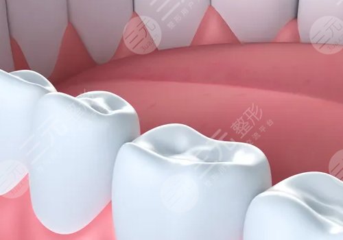 種植滿口牙大概需要多少錢?