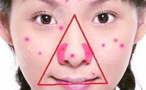 激光祛痘能去掉嗎?